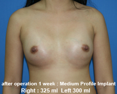 plastic-surgery-breast-augmentation